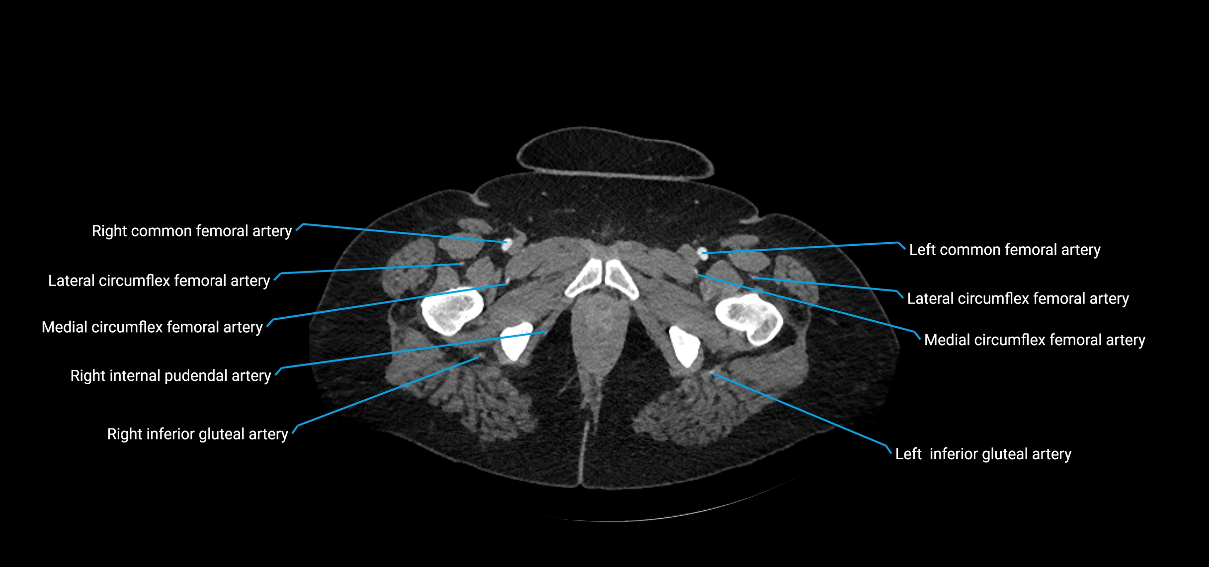 CTA abdomen axial cross sectional anatomy labelled image_270 (2).webp